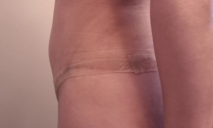 Area del ombligo inflamada tras abdominoplastia - 79506