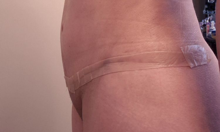 Area del ombligo inflamada tras abdominoplastia - 79507