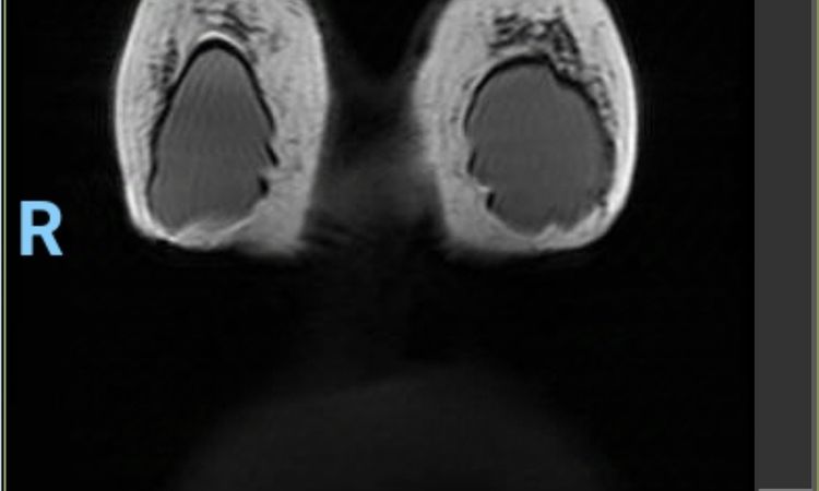 Mastopexia con implantes, pecho aplastado. Resonancia magnética - 79540