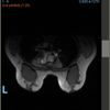 Mastopexia con implantes, pecho aplastado. Resonancia magnética