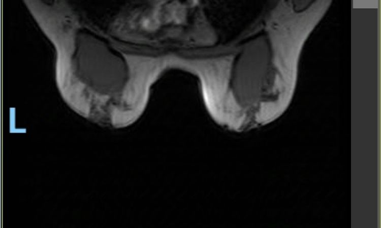 Mastopexia con implantes, pecho aplastado. Resonancia magnética - 79541