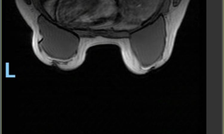 Mastopexia con implantes, pecho aplastado. Resonancia magnética - 79542