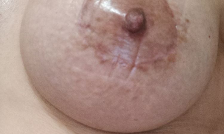 Uso del tratamiento para evitar cicatrices queloides tras mastopexia - 79568