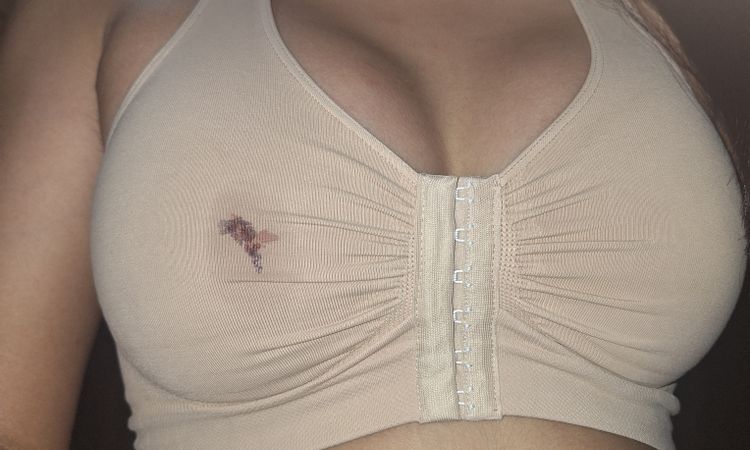 Post operatorio de pechos, tengo calor en los pezones! - 79574