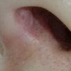 Rinoplastia engrosamiento del tabique