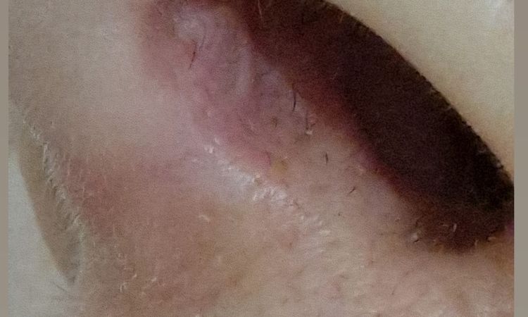 Rinoplastia engrosamiento del tabique - 79973