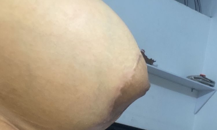 Seno en forma de cono tras 6 meses de mastopexia - 80079