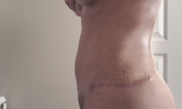 Abdominoplastia inflamada a 4 meses - 80176