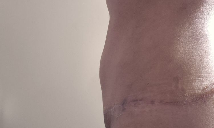 Abdominoplastia inflamada a 4 meses - 80177