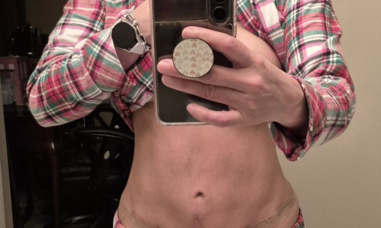 Abdominoplastia inflamada a 4 meses - 80178