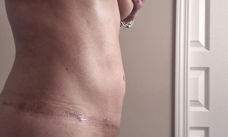 Abdominoplastia inflamada a 4 meses - 80179