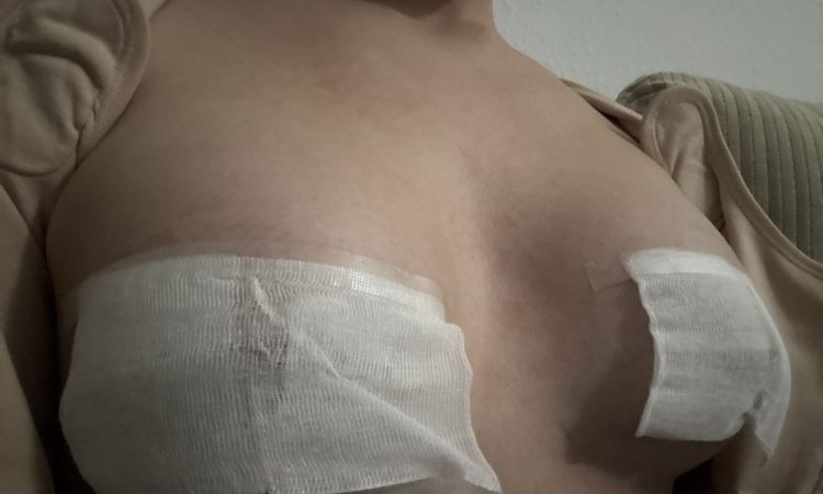 Tengo mucho espacio en el canalillo tras mamoplastía - 80341