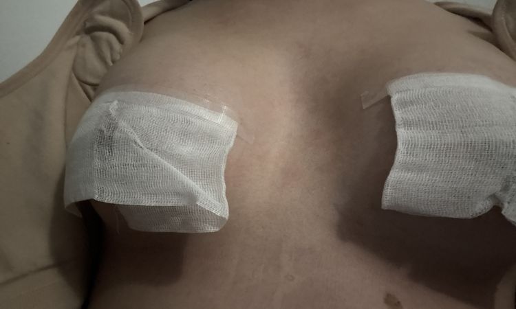 Tengo mucho espacio en el canalillo tras mamoplastía - 80342