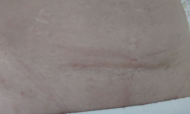 Arreglo cesárea por que quedo mal - 80447
