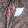 Unir pliegues de la labioplastia