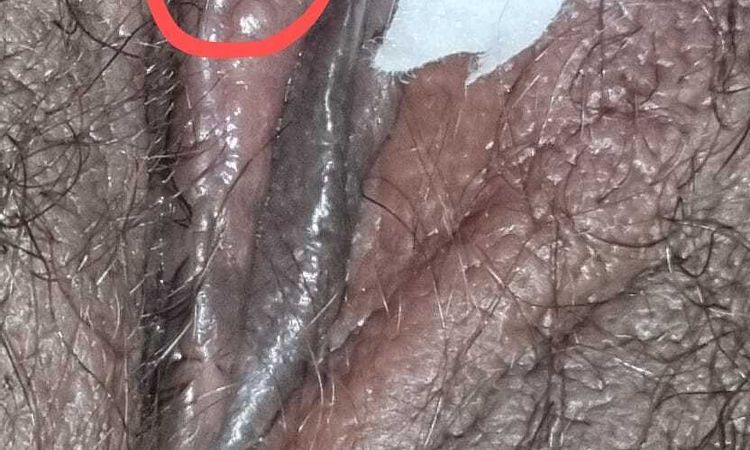 Unir pliegues de la labioplastia - 80490