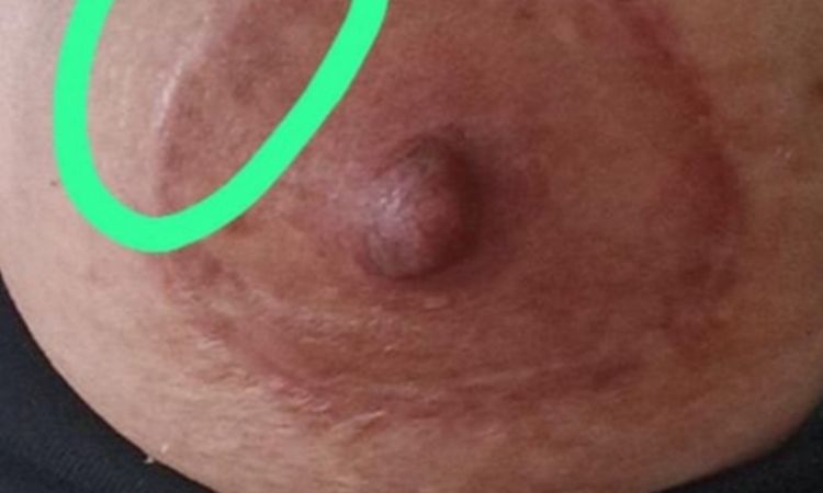 Cremas tratamiento mastopexia periaerolar - 80809