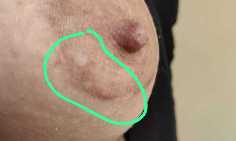 Cremas tratamiento mastopexia periaerolar - 80810