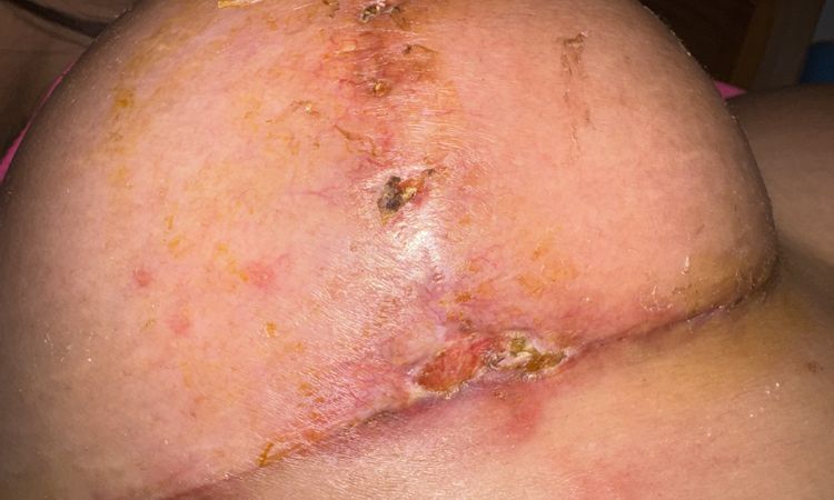 Cicatriz de mastopexia - 80877