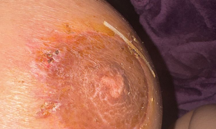 Cicatriz de mastopexia - 80879