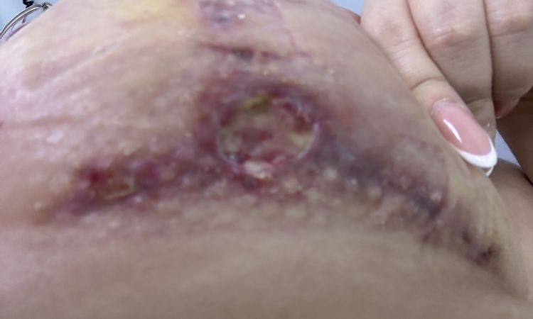 Se me abrieron los puntos - 81005