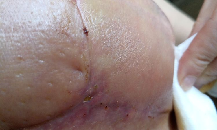 ¿Os parece que tengo infección? En mastopexia de reducción. - 81108