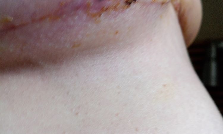¿Os parece que tengo infección? En mastopexia de reducción. - 81109
