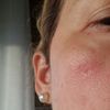 Ampolla tras Ipl facial