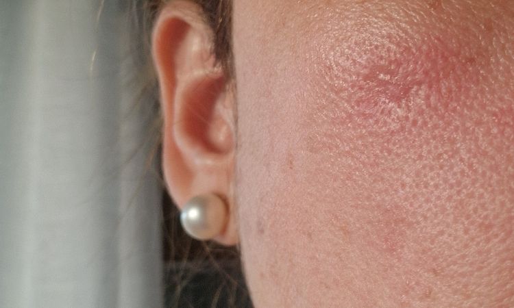 Ampolla tras Ipl facial - 81136