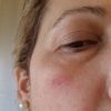 Ampolla tras Ipl facial
