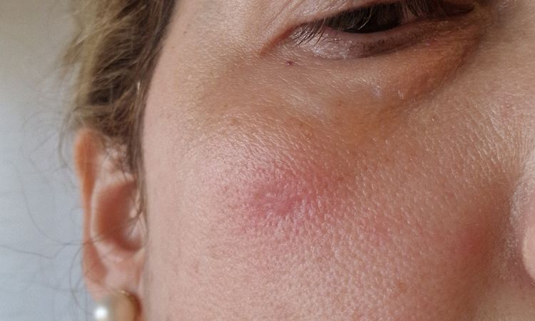 Ampolla tras Ipl facial - 81137