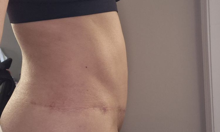 Pubis inflamada después de abdominoplastia - 81145