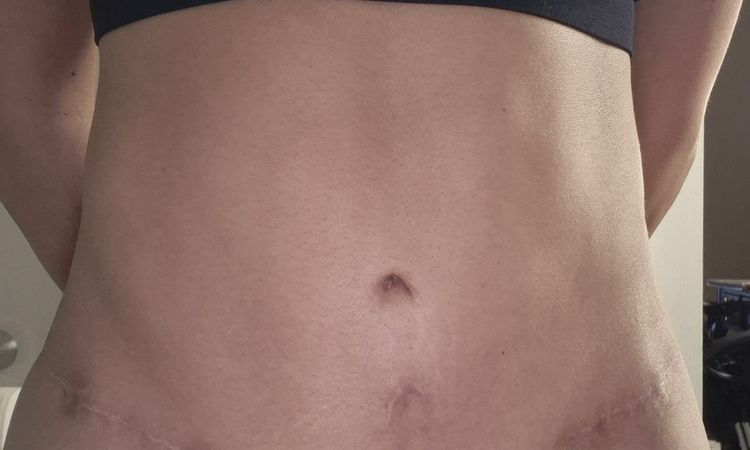 Pubis inflamada después de abdominoplastia - 81146