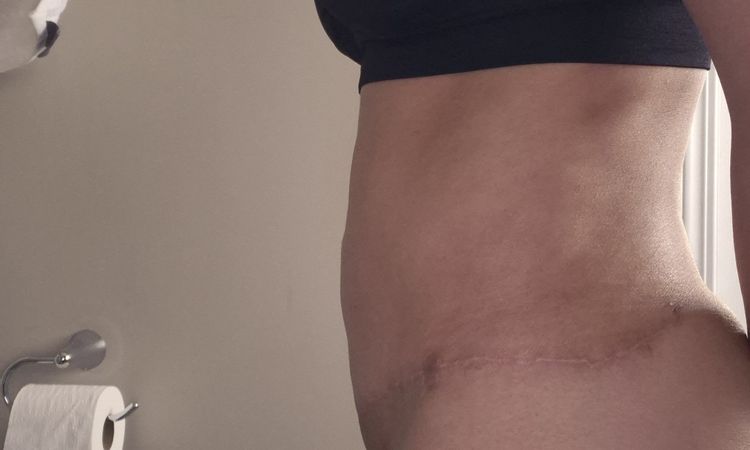 Pubis inflamada después de abdominoplastia - 81147