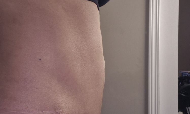 Pubis inflamada después de abdominoplastia - 81148