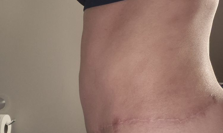 Pubis inflamada después de abdominoplastia - 81149