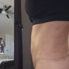 Pubis inflamada después de abdominoplastia