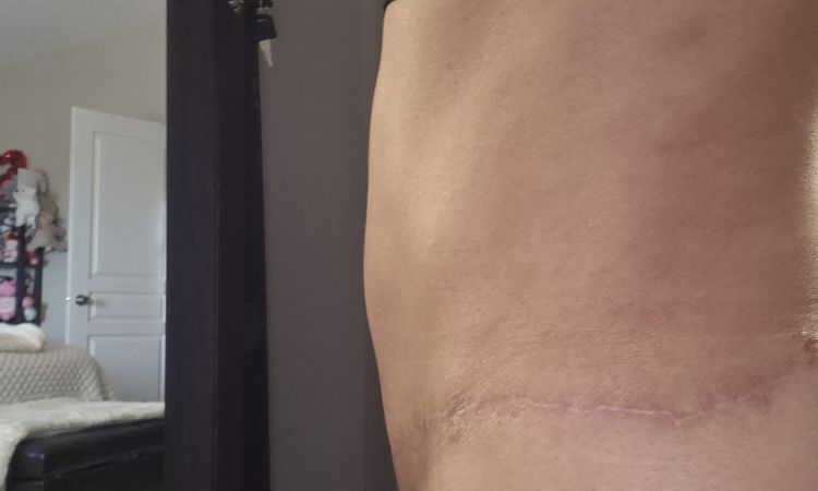 Pubis inflamada después de abdominoplastia - 81150