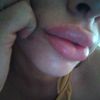¿Que tiene que ver un resfrío con que se hinchen los labios ?