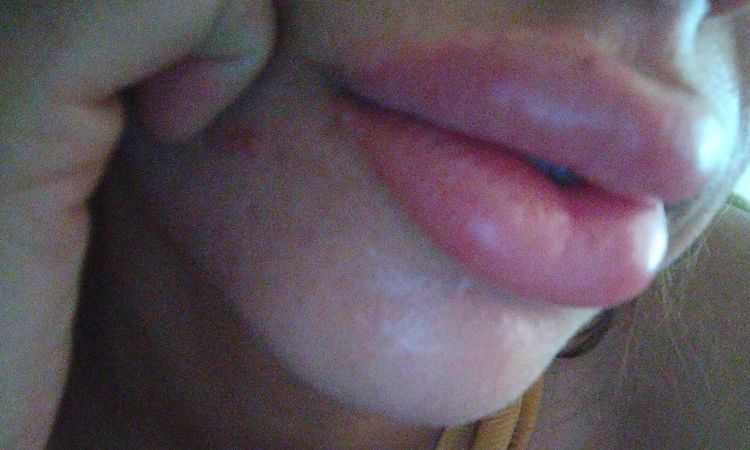 ¿Que tiene que ver un resfrío con que se hinchen los labios ? - 81163
