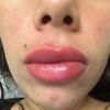 Inflamación en labios tras 2 años de ácido hialurónico
