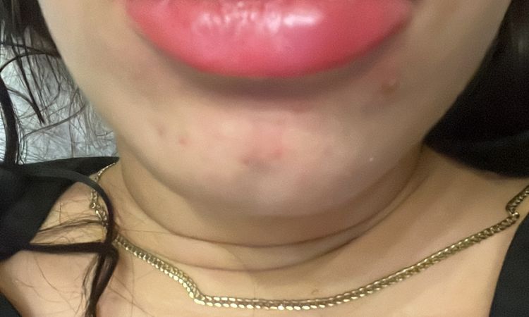 Inflamación en labios tras 2 años de ácido hialurónico - 81235