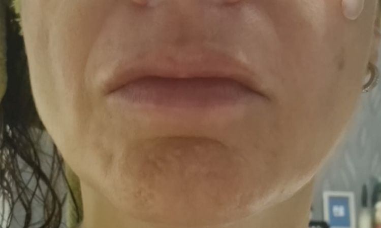 Abultamiento sobre el labio y lados desiguales - 81236