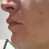 Abultamiento sobre el labio y lados desiguales
