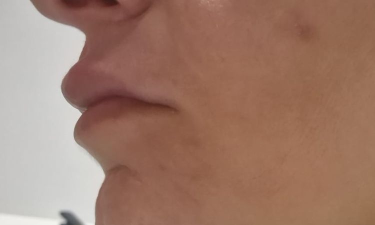 Abultamiento sobre el labio y lados desiguales - 81237
