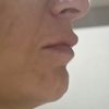 Abultamiento sobre el labio y lados desiguales