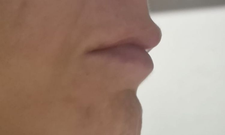 Abultamiento sobre el labio y lados desiguales - 81238