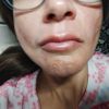 Abultamiento sobre el labio y lados desiguales