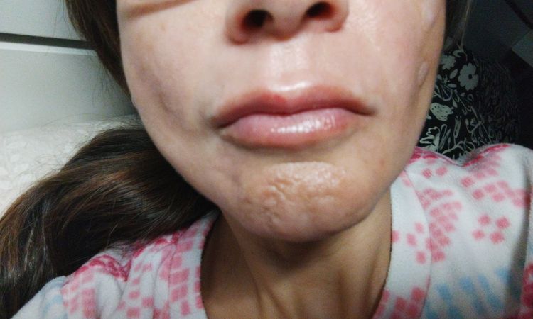 Abultamiento sobre el labio y lados desiguales - 81239