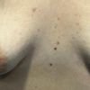 ¿Mama tuberosa mal corregida?